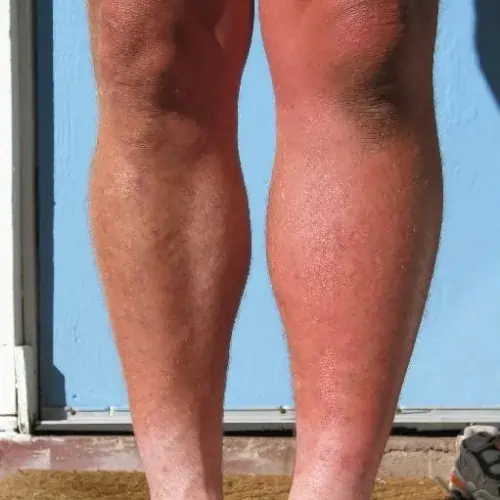 Swelling in one leg
