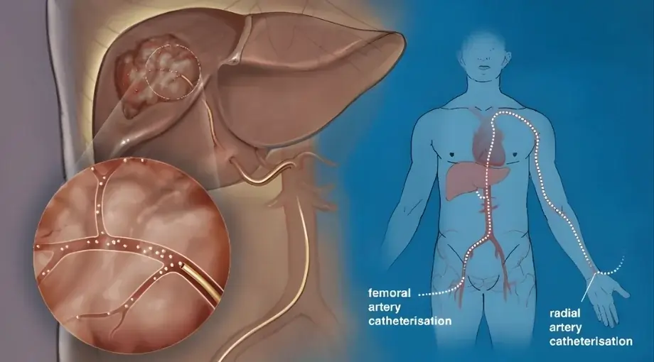TACE (Trans-Arterial Chemoembolization)