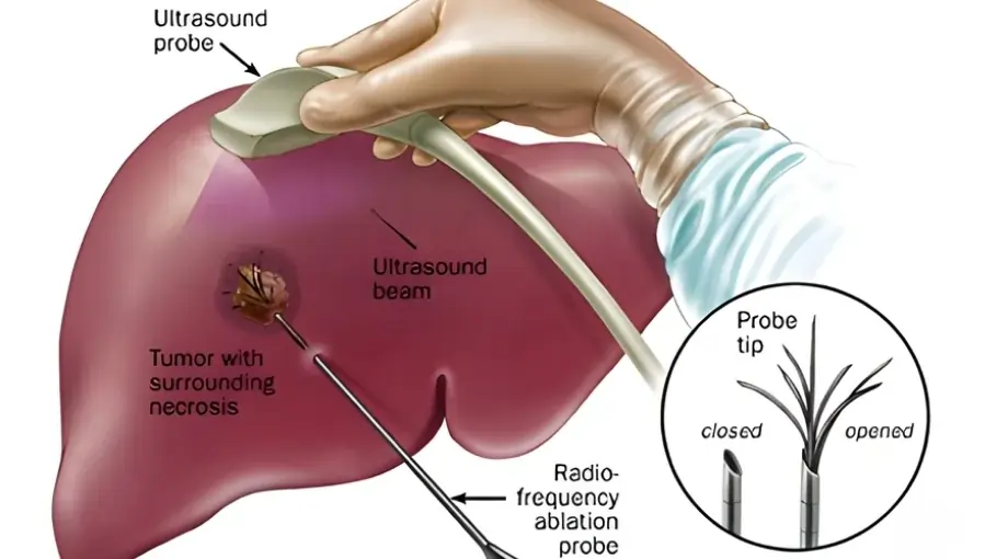 Tumor Ablation