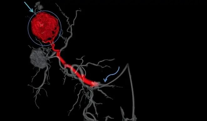 What Is TACE (Trans-Arterial Chemoembolization)?