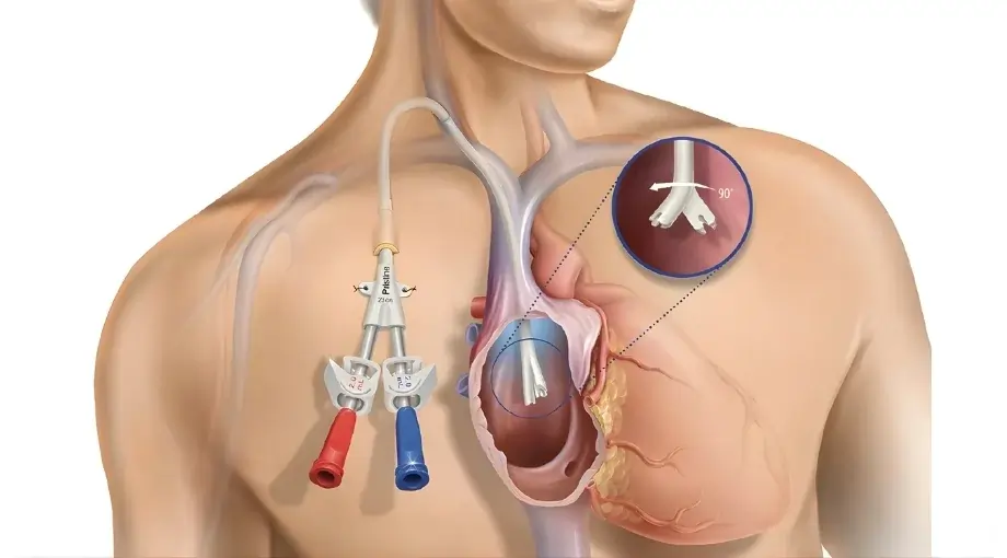 Hemodialysis Catheter Insertion