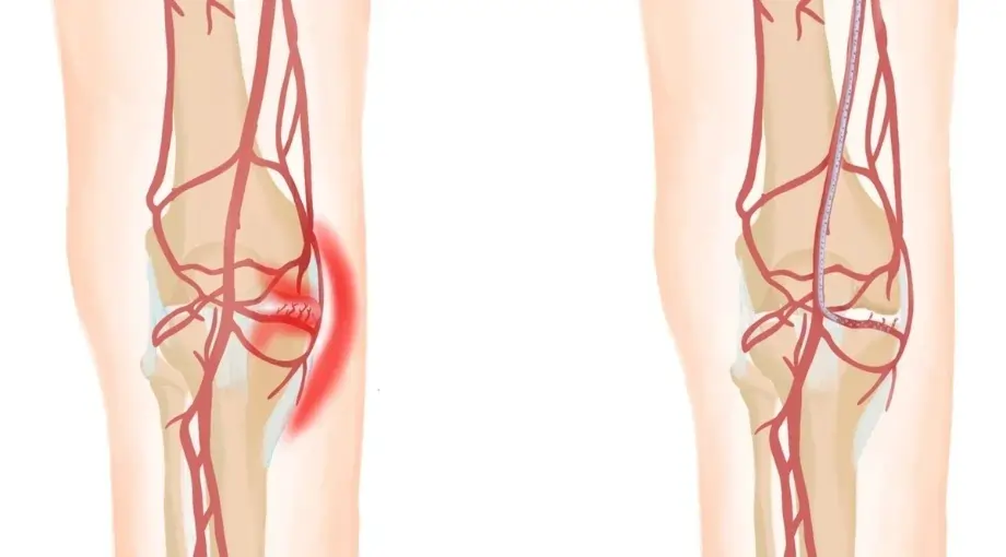 Genicular Artery Embolisation (GAE)