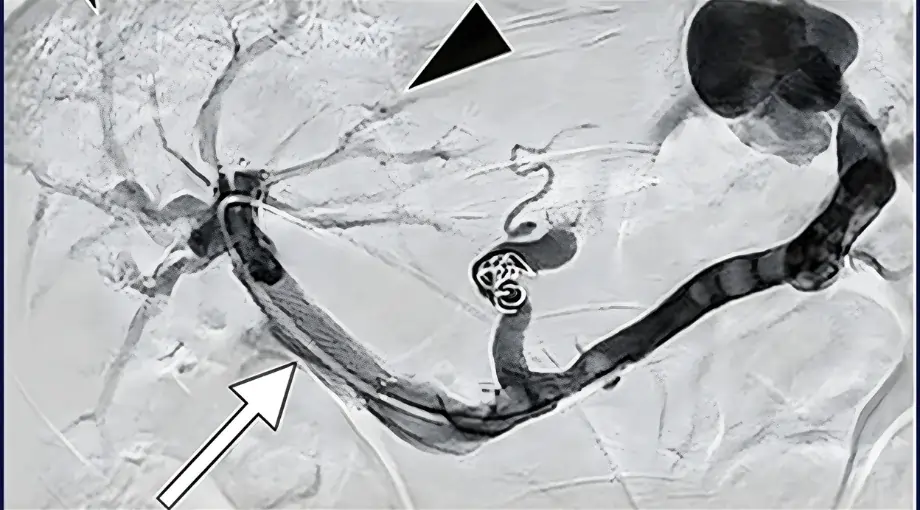 Portal Vein Stenting