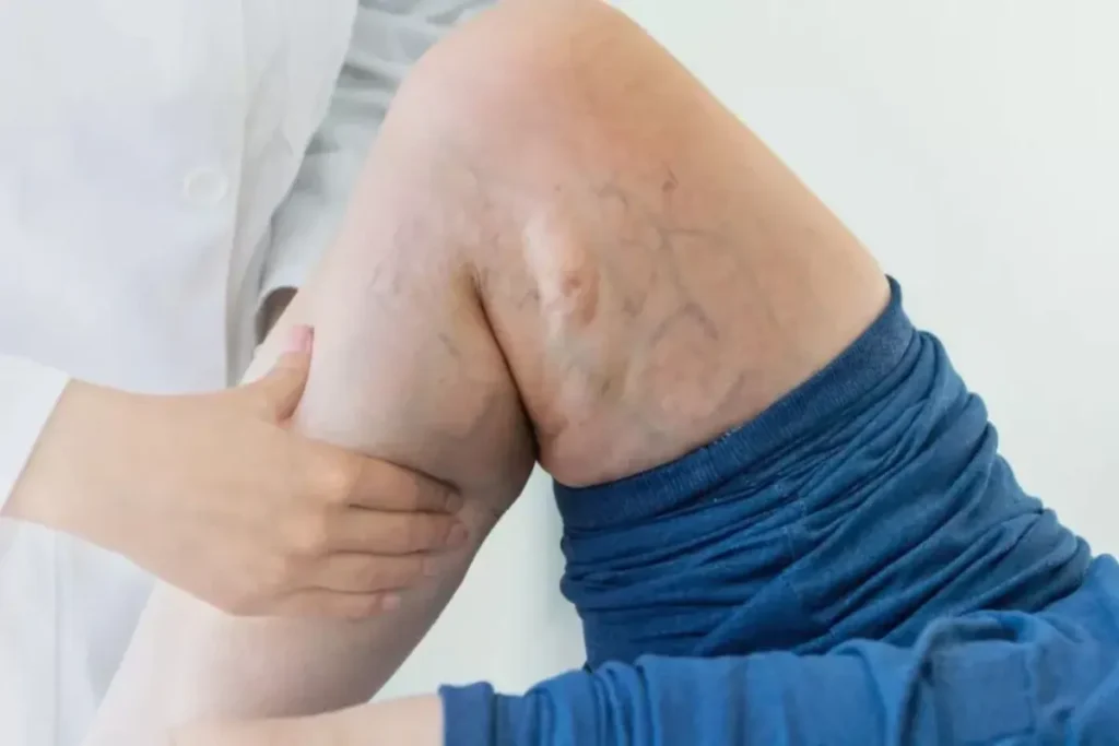 May-Thurner Syndrome