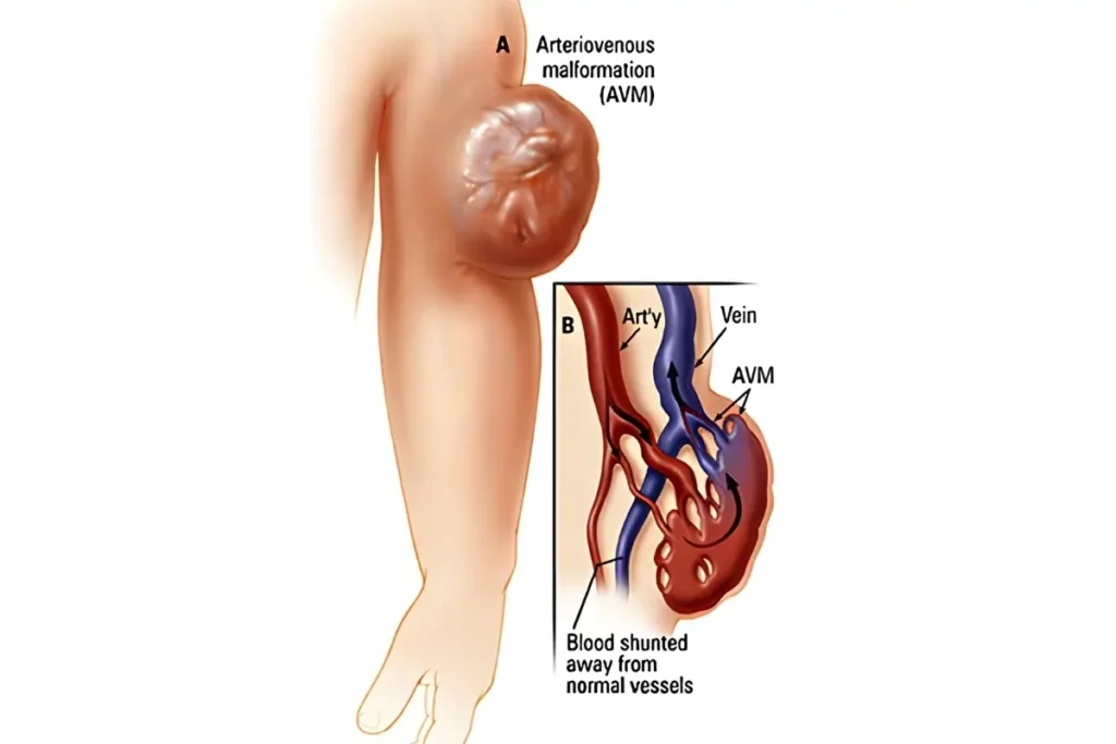 Pre-Operative Embolization of Vascular Tumors