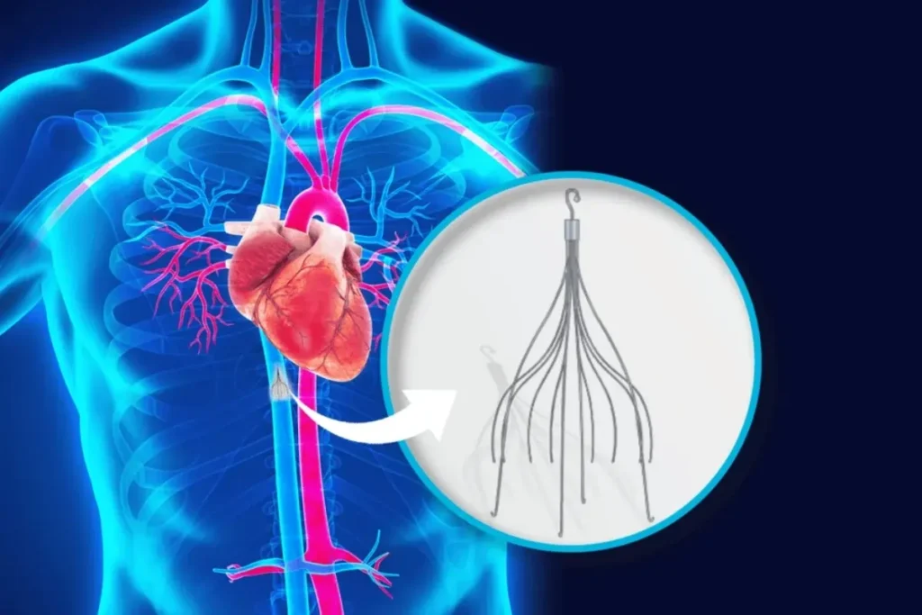 IVC Filter: Placement & Removal