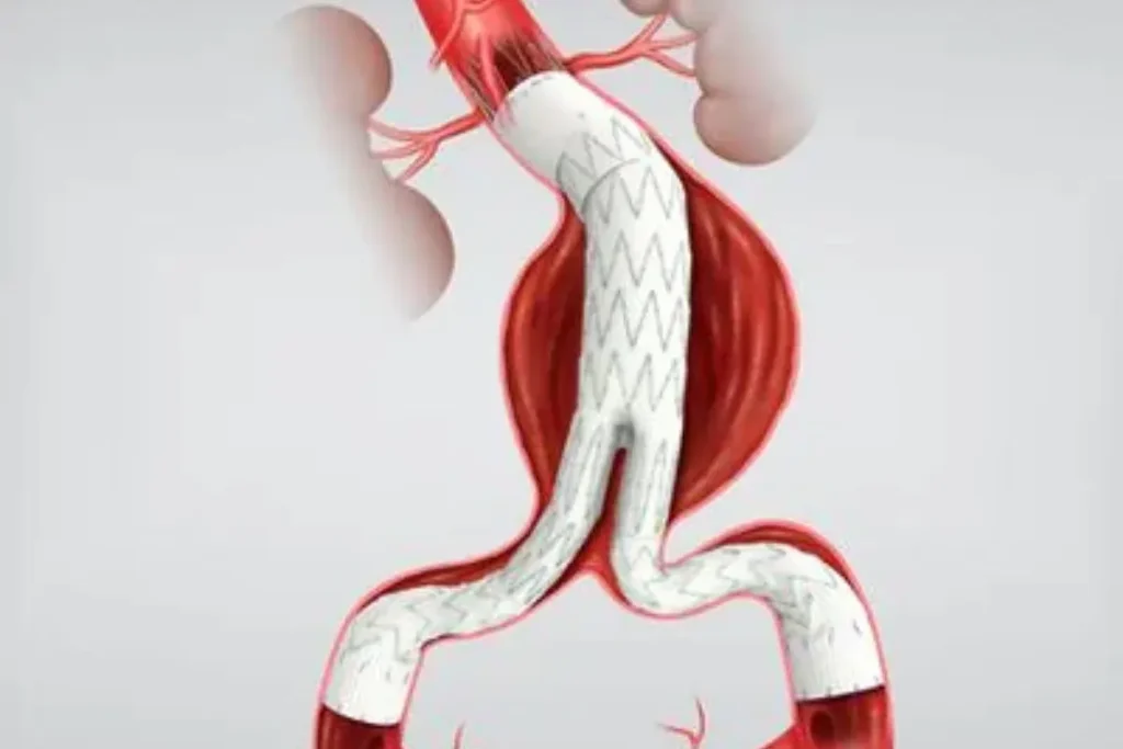 Aortic Aneurysm Stent Graft (EVAR)