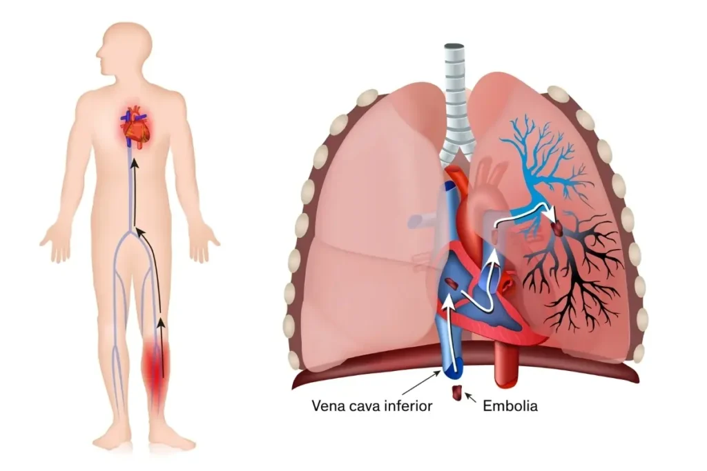 Pulmonary Thromboembolism (PTE)