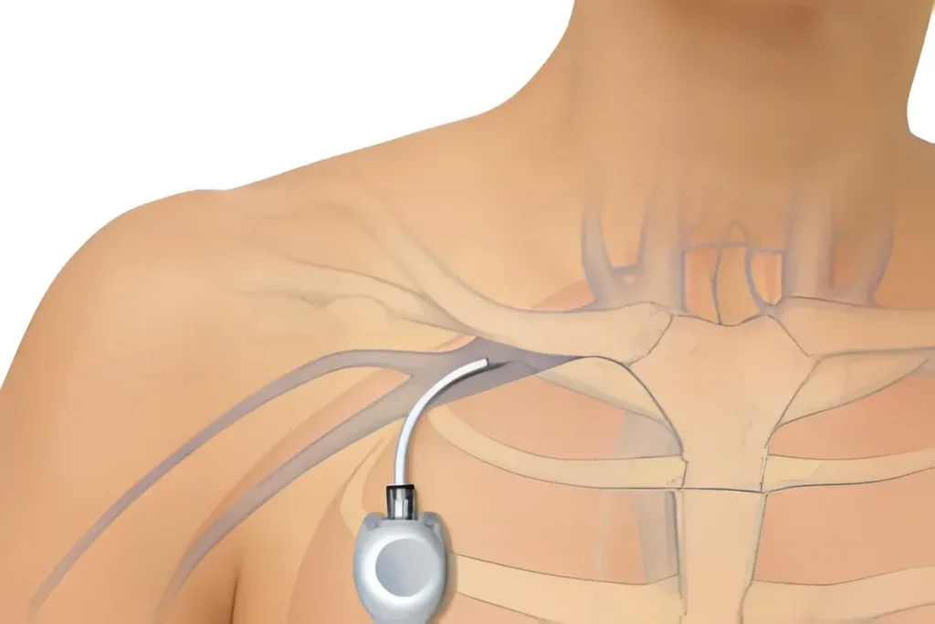 Chemo-Port Placement