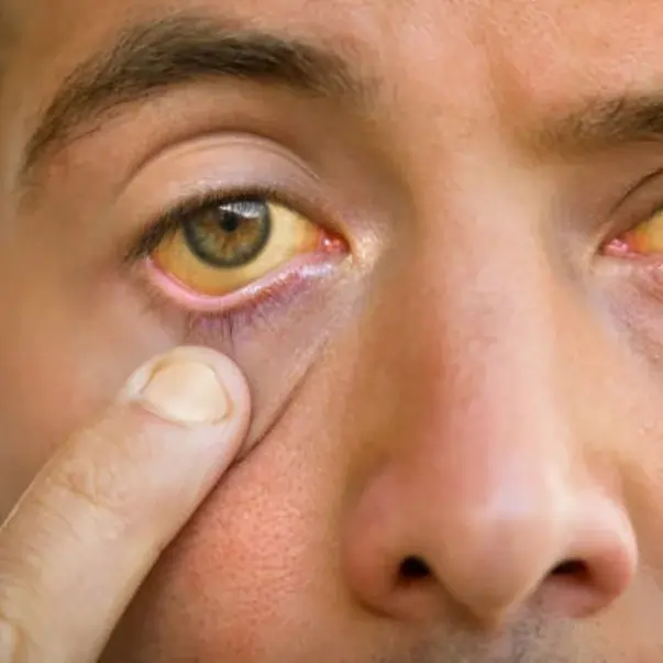 Jaundice or liver-related symptoms