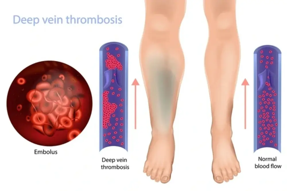 What is Deep Vein Thrombosis?