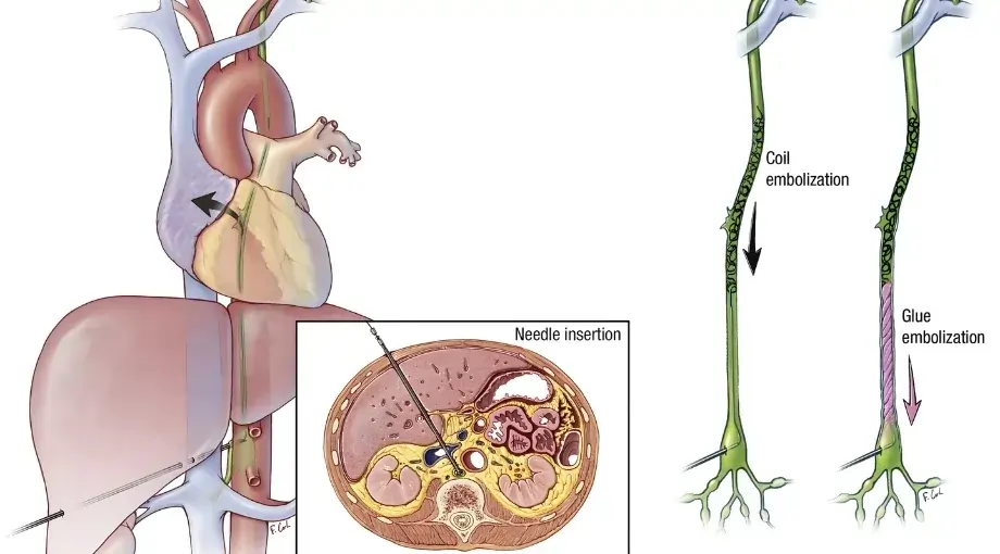 Thoracic Duct Embolisation